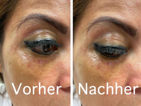 Vorher_Nachher